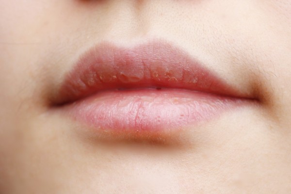 秋天嘴唇干裂是什么原因?