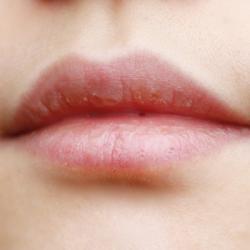 嘴唇干裂脱皮是什么原因？